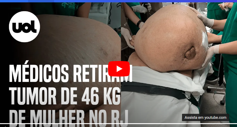 Leia mais sobre o artigo Vídeo / Mulher tem tumor de 46 kg retirado em cirurgia de emergência no RJ